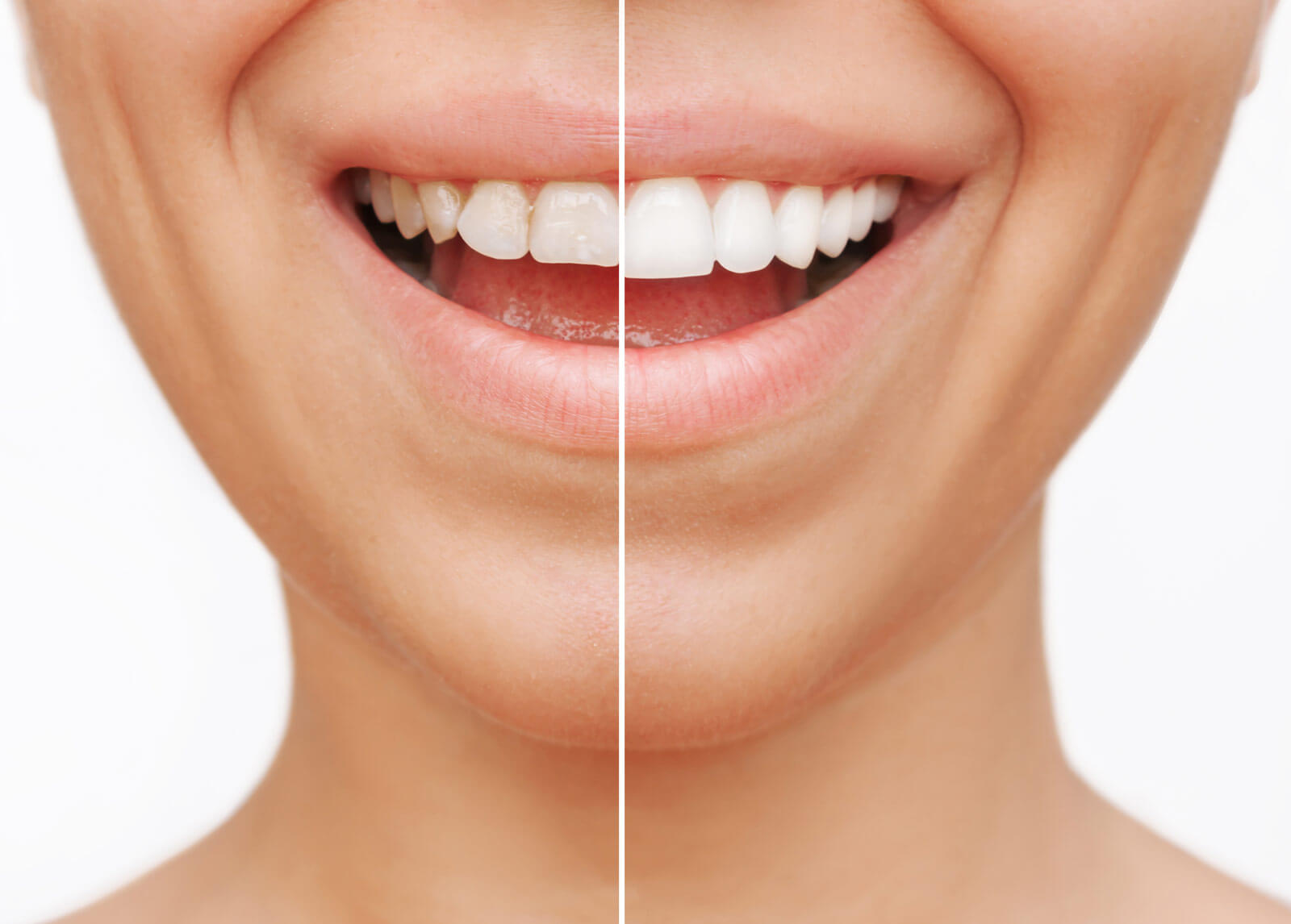 Veneers in der Zahnarztpraxis Maybachvilla Frankfurt
