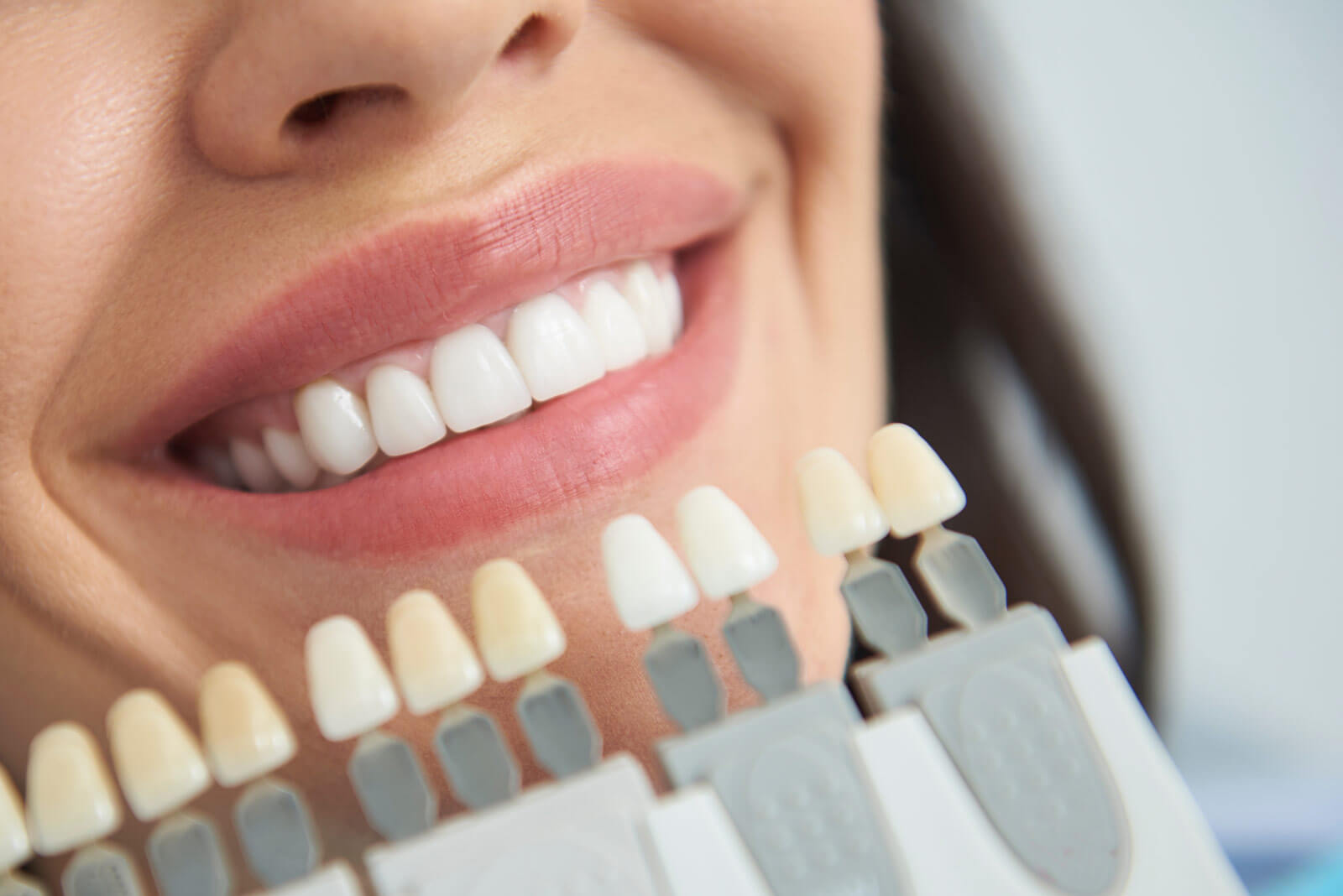 Veneers in der Zahnarztpraxis Maybachvilla Frankfurt